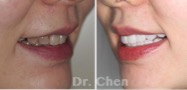 上下颌前牙瓷贴面修复中度四环素牙