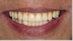 无牙颌种植修复（all on four）